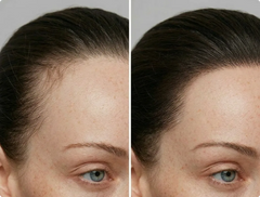 Receding Hairline