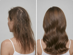 Postpartum Hair Loss